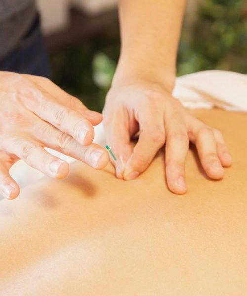 From above of crop anonymous man applying needles on back of client during acupuncture procedure