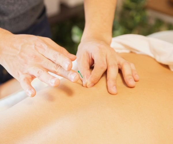 From above of crop anonymous man applying needles on back of client during acupuncture procedure