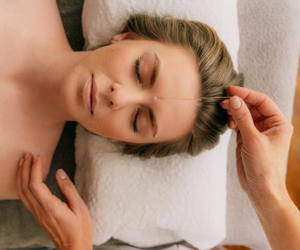 Serene acupuncture treatment focusing on relaxation and wellness in a spa setting.